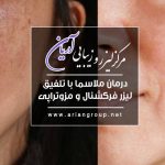 درمان ملاسما با تلفیق لیزر فرکشنال و مزوتراپی