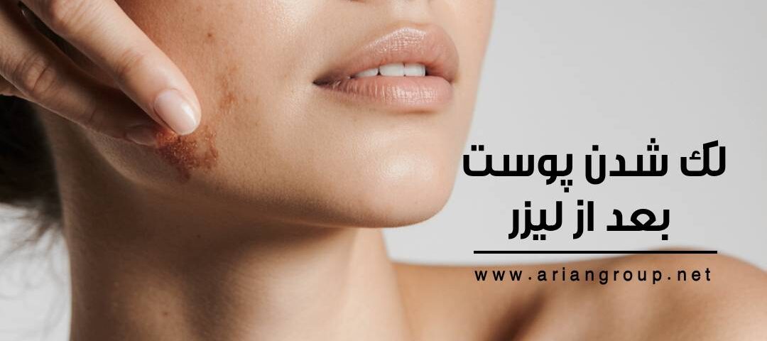 لک شدن پوست بعد از لیزر