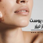 لک شدن پوست بعد از لیزر