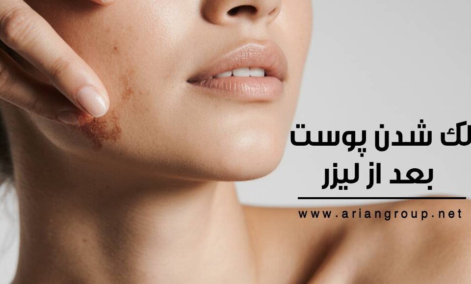 لک شدن پوست بعد از لیزر