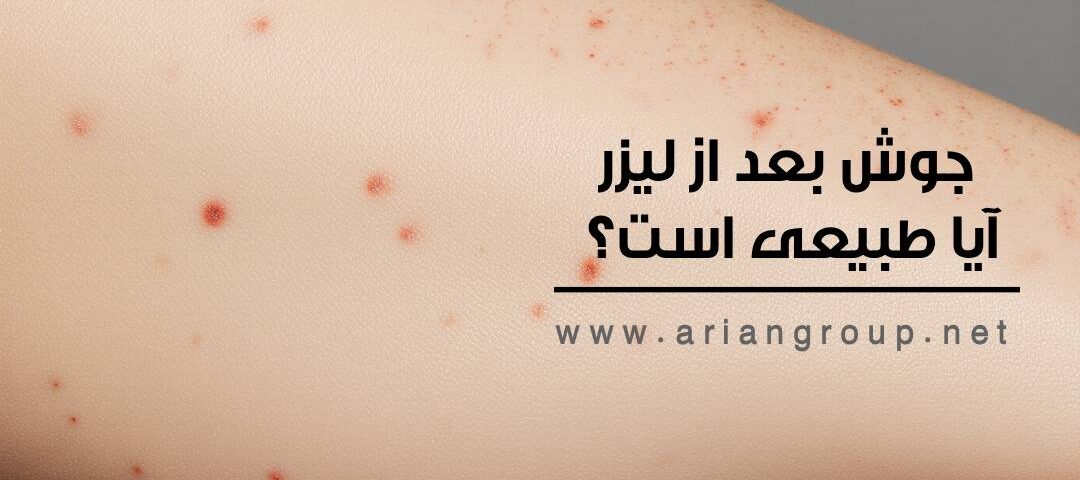 جوش بعد از لیزر؛ آیا طبیعی است؟ دلایل و راه‌های درمان سریع آن