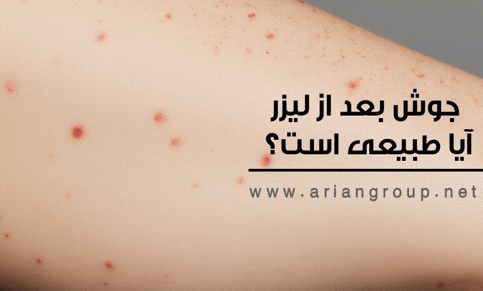 جوش بعد از لیزر؛ آیا طبیعی است؟ دلایل و راه‌های درمان سریع آن