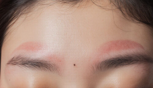 واکنش طبیعی پوست به انرژی حرارتی لیزر