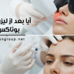 بوتاکس بعد از لیزر