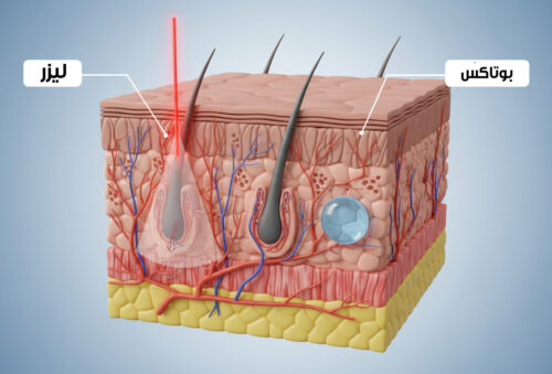 تداخل لیزر و بوتاکس در لایه های پوست