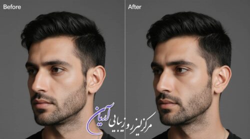 نتیجه قبل و بعد از زاویه سازی فک مردان با تزریق فیلر