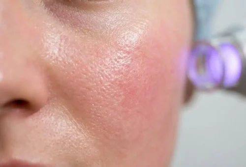 مکانیسم فتوترمولیز